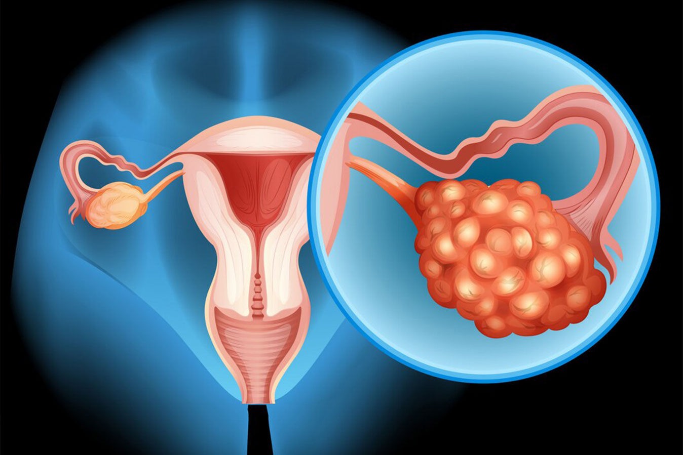 Genitourinary Cancers