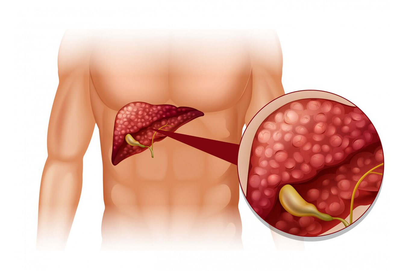 Hepato-pancreatico-biliary Cancers