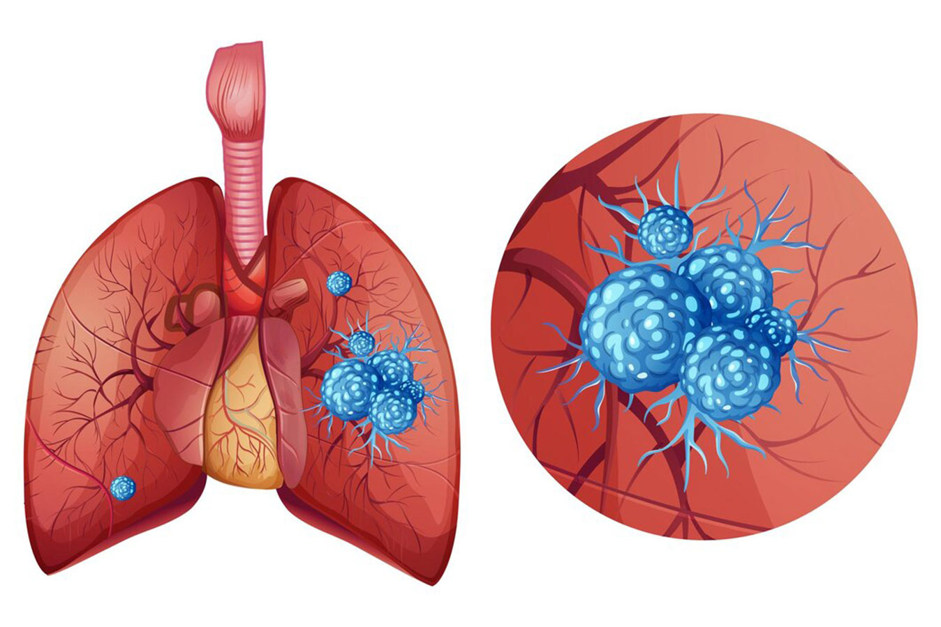 Lung-Cancer